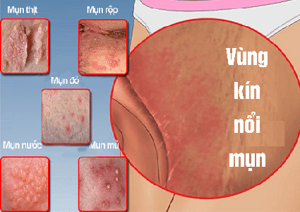 vung-kin-noi-mun.png