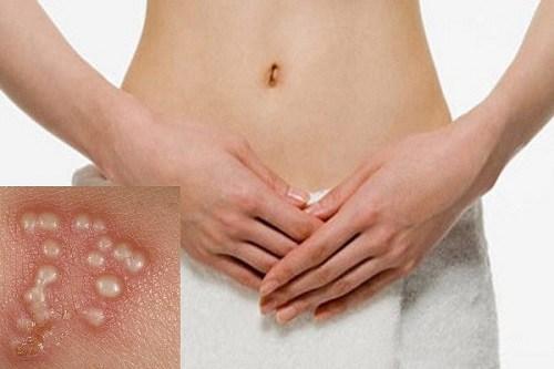 herpes-la-benh-gi2.jpg