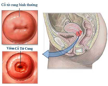 dau-hieu-nhan-biet-viem-co-tu-cung-ban-nen-biet-1.jpg