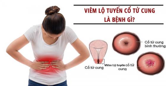 1-hinh-anh-viem-lo-tuyen-co-tu-cung-benh-ly-thuong-gap-o-nu-trong-do-tuoi-sinh-no.jpg